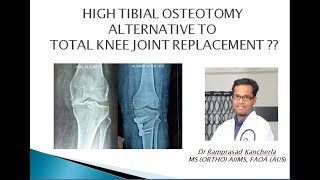 High tibial osteotomy Alternative to Total knee Joint replacement  kneepain jointreplacement [upl. by Letney]