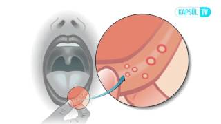 Aft Ağız Yarası Nedir [upl. by Saxela]