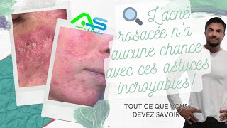 ⚡️Acné Rosacée Voici la solution DEFINITIVE pour vous en débarrasser✨ [upl. by Jolene492]