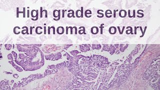 High Grade Serous Carcinoma of Ovary  Pathology mini tutorial [upl. by Eyde]