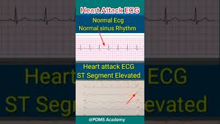 ECG changes During Heart Attack medicine ecg [upl. by Suneya819]