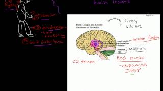 Parkinsons Dementia [upl. by Almita]