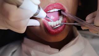 How teeth cleaning is done   DENTAL SCALING  FMS DENTAL HOSPITALS [upl. by Aerona]