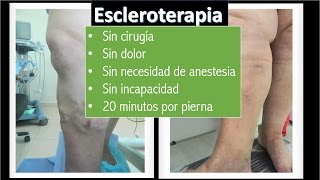 ESCLEROTERAPIA cura las venas varices SIN cirugia  especialista en varices en Bogota [upl. by Wynn]