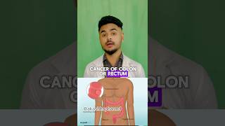 Colorectal Cancer Alert 🚨 Pharmd colorectalcancer cancer colorectalcancerawareness [upl. by Arraik]