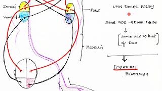 Hemiplegia CVA  Stroke  Theory amp Clinical discussion [upl. by Toffic]