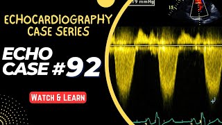 ECHO CASE 92  Echocardiography for Beginners  Echocardiogram Interpretation  2D Echo Basics [upl. by Hsina]