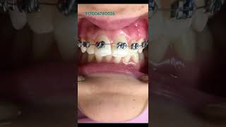 Class 1 Malocclusion with increased overjet  Braces anantnag braces dentist orthodontist usa [upl. by Arden]