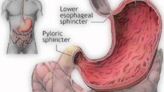 Peptic Ulcer Disease and H Pylori [upl. by Yendys]