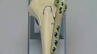 High Tibia Valgisation Osteotomy HTO Open wedge With The Tomofix System [upl. by Ram]