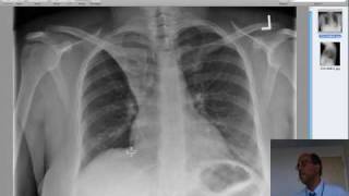 right upper lobe collapse due to mucous plug in an asthmatic [upl. by Asilehc]