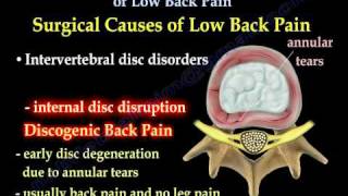 Low Back Painsciatica Disc surgery Everything You Need To Know  Dr Nabil Ebraheim [upl. by Olrac]