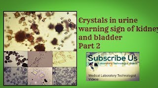 Crystals in Urine  Health warning sign of Kidney and bladder Part 2 [upl. by Ojeillib]