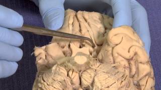 Olfactory Neuroanatomy Video Lab  Brain Dissections [upl. by Gelasius]