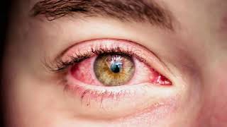 What is Eye Strain and How to prevent Eye Strain [upl. by Elinet]