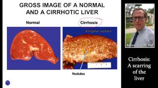 CIRRHOSIS LIVER SCARRING by Dr Robert Gish [upl. by Kciwdahc]