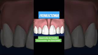 FRENECTOMIA dentist smile ecuador shorts frenillos dream sonrisa sonris [upl. by Ardnoel]