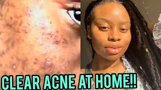 RETINOL CLEARED MY ACNE CLEAR SKIN ROUTINE FOR HYPERPIGMENTATION DARK SPOTS AND PIMPLES [upl. by Hahcim16]