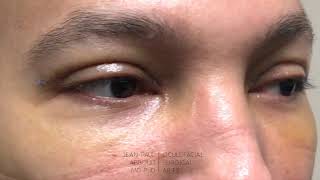 Upper Eyelid Blepharoplasty One Week After Surgery [upl. by Hamann]