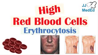 High Red Blood Cells Erythrocytosis  Causes Signs and Symptoms and Treatment [upl. by Atilahs]