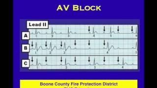 ECG 15 Dropped Beats [upl. by Aokek711]