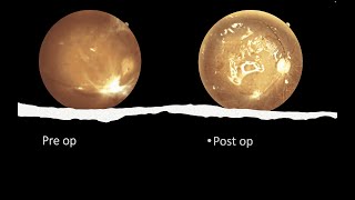 vitrectomy in vitreous haemorrhage with focal traction [upl. by Jeb]