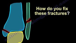 Ankle Fractures Surgical Treatment tactics  Everything You Need To Know  Dr Nabil Ebraheim [upl. by Marras]