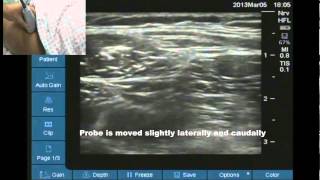 Ultrasound location of lateral femoral cutaneous nerve [upl. by Peltier]