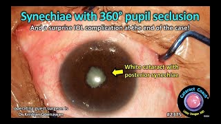 CataractCoach™ 2375 synechiae with 360 degree pupil seclusion [upl. by Eenel]