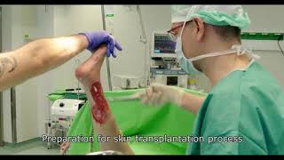 Negative Pressure Wound Therapy amp Skin Grafting Technique HARTMANNDIMANTEC [upl. by Vin]