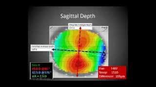 Corneal GP Lenses Video 1 [upl. by Nnylakcaj254]