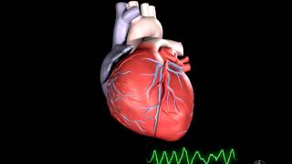 What is Ventricular Fibrillation [upl. by Rodenhouse]