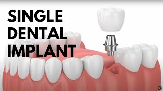 Single Dental Implant Procedure Animated [upl. by Ahsilek]