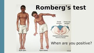 Rombergs test [upl. by Tegirb]