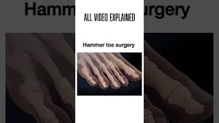 Hammer toe surgery hammertoe footsurgery podiatry foothealth surgeryrecovery [upl. by Aehr]