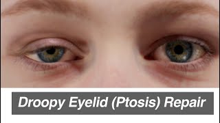 Droopy Eyelid Ptosis Repair [upl. by Whitver]