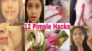 Pimple को रात भर में ठीक करने के 12 आसान तरीके12 Hacks to Remove Pimple OvernightBe Natural [upl. by Tnomyar]