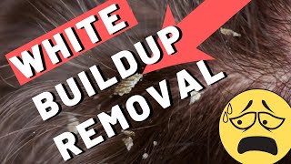 White Buildup on Scalp  How To Remove It [upl. by Anoit445]