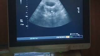 Osseous metaplasia uterus pelvicultrasound pathology [upl. by Anni]