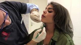 ultherapy for Neck Tightning [upl. by Eiramacissej]