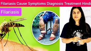 Filariasis Cause Symptoms Diagnosis Treatment in Hindi  Filariasis Cause by  What is Filariasis [upl. by Madalena205]