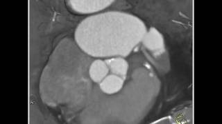 Cardiac Dilated ascending aorta in a patient with aortic stenosis 4 of 4 [upl. by Akemehc]