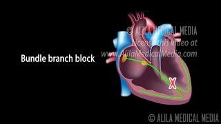 Types of Heart Blocks Narrated Animation Part 1 [upl. by Ahcsat]