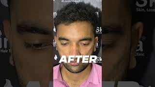 Skinaa Hair Transplant  Amazing Before amp After Results viral shorts [upl. by Lleoj]