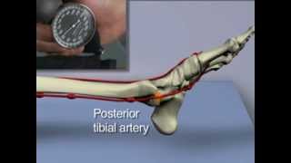 AnkleBrachial Index for Assessment of Peripheral Arterial Disease [upl. by Norda]