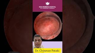 Endometrial Polyp surgery  DrChinmay Pataki  Isha Women’s Hospital  polypterus [upl. by Mohammed344]