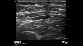 Fascia iliaca nerve block [upl. by Stephani]