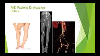 SIRRFS Webinar 362018 Peripheral Arterial Disease [upl. by Radnaskela535]