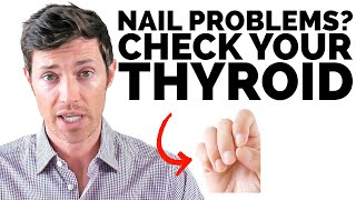 What Your Nails Tell You About Your Thyroid Health [upl. by Lamrej]