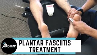 Plantar Fasciitis Treatment San Diego Graston Chiropractic [upl. by Adnical8]